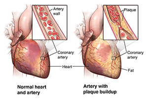 The heart and arteries, showing plaque build-up in arterial wall.